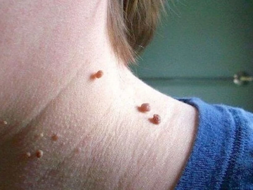 أقوى علاج للثالول