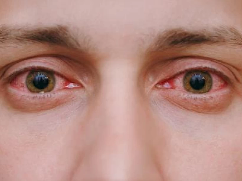 متلازمة هيتروكروميا وأنواعها