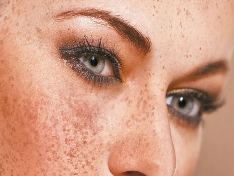 الكلف الكلف