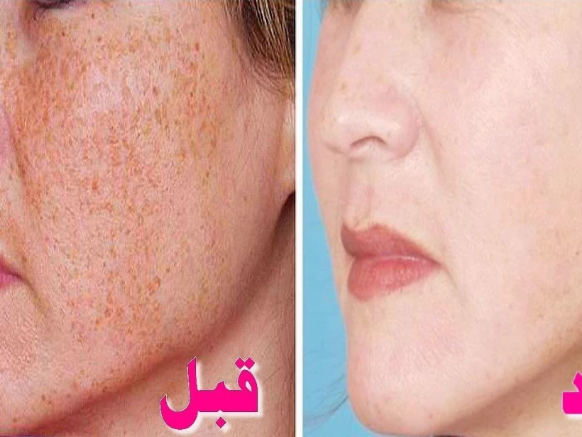 التقشير-الكربوني التقشير-الكربوني