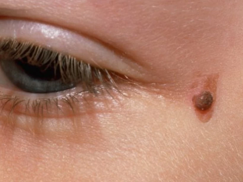 أقوى علاج للثالول