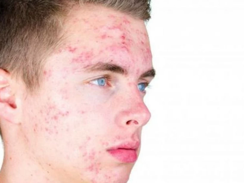 التخلص-من-حب-الشباب التخلص-من-حب-الشباب