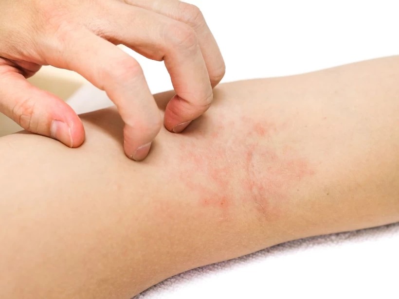 الشري التحسسي