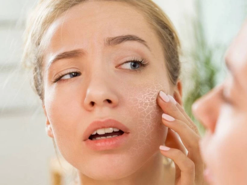 مشاكل-البشرة-الجافة مشاكل-البشرة-الجافة