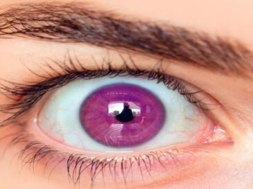 متلازمة هيتروكروميا وأنواعها