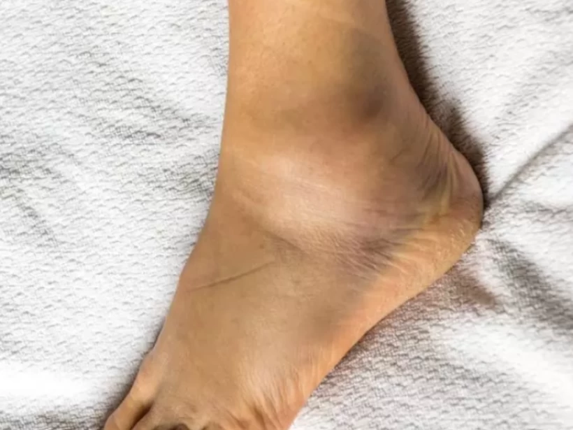 تورم-القدمين تورم-القدمين